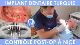 Implant dentaire Turquie  Suivi dentiste à Nice [upl. by Reta]