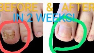 Kerasal  1 in Fungal Nail Removal Toenails amp Figure Nails IT WORKS HowTO Get Rid of Nail Fungus [upl. by Teddman]