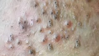 Blackheads amp Whiteheads Satisfying Removal 0072 [upl. by Valtin313]