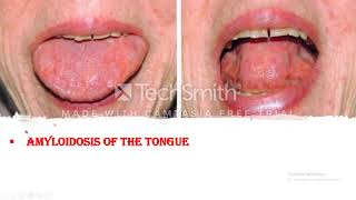 Amyloidosis Clinical course Symptoms and Signs Diagnosis and Prognosis of the disease [upl. by Assiluj645]