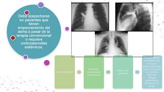 ASPERGILLOSIS BRONCOPULMONAR ALÉRGICA [upl. by Ranson]