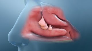 Nasal Polyp Removal Surgery [upl. by Mears926]