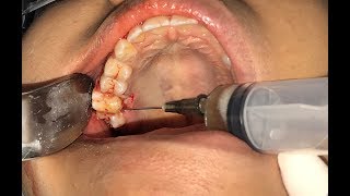 Tooth autotransplantation  Transplante dentário [upl. by Nnep768]