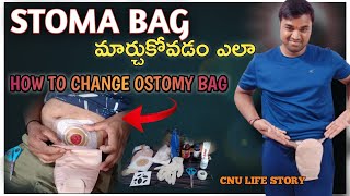 నేను STOMA BAG ని ఎలా మార్చుకుంటానో చుడండి  How to change Ostomy bag in Telugu [upl. by Bartlet]