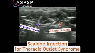 Scalene Injection for Thoracic Outlet Syndrome [upl. by Yanaj]