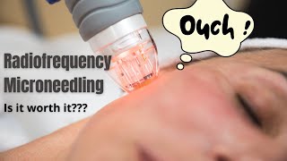 Radiofrequency Microneedling  Does it actually work  Dermatologist reviews [upl. by Mrots641]