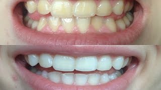 How I whitened my VERY yellow teeth WORKS BEFORE AND AFTER [upl. by Ayin201]