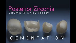 Zirconia Ceramics Part 5 Posterior Onlay 34 Vonlay and Crown Cementation [upl. by Hubert]