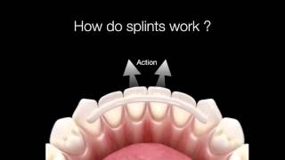 How Do Dental Splints Work [upl. by Matthaus]