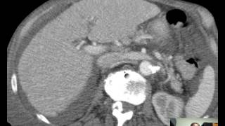 CT Thorax Anatomy DISCUSSION 37min [upl. by Ajram]