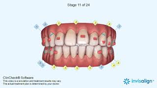 Invisalign ClinCheck® [upl. by Hans]