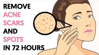 How to Get Rid of Acne Scars and Spots in 72 Hours [upl. by Enoob]