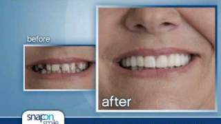 SnapOn Smile Commercial for Dr J Goldsmith DDS FAGD [upl. by Nerrag590]