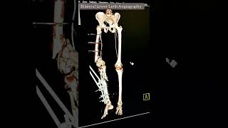 bilateral Lower Limb Angiography CT scan video 3d 2d mip angiography ctscan cbct [upl. by Asilehs]