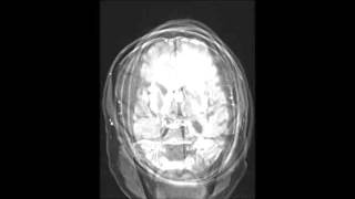 Primary CNS Lymphoma [upl. by Adnir865]