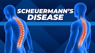 Top Three Exercises for Scheuermanns Disease [upl. by Anirrok917]