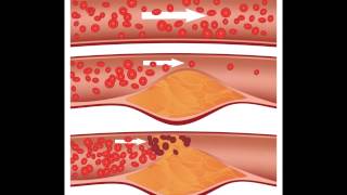 cholesterol medications  New Drug May Help Lower Bad Cholesterol Beyond Statins [upl. by Akinahs658]