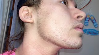 Every Single Picture of Minoxidil and Derma roller Beard Growth Week 1  16 [upl. by Bekah]