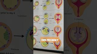 dizygotic and monozygotic definition for TWINS Pregnancy 😳😍 [upl. by Aundrea832]