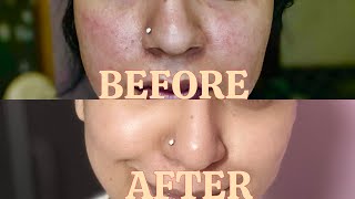 How I restored my damaged skin barrier in 4 days with just 4 products  Simple and Easy [upl. by Atikihc]