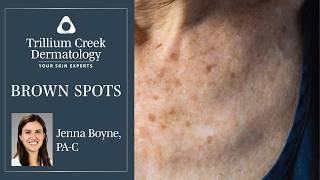 What are those Brown Spots on your skin [upl. by Olivie]