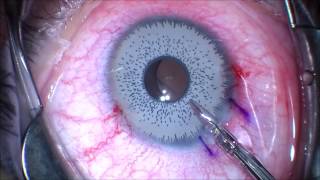 Want to change your eye color Think twice Iris Implant Removal JT Kavanagh MD San Antonio TX [upl. by Mcclain40]