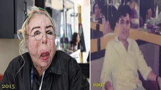 Mexican Man Damage His Face After Baby Oil Injecting Was Big Mistake [upl. by Natsirt]