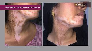 Melanocyte Transplantation  Vitiligo  Leukoderma Treatment  Dr Venkata Ramana Yamani  Contours [upl. by Oler859]