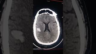 Mri And Ct Scan different show blood [upl. by Gnep]