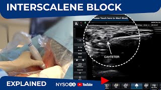 UltrasoundGuided Continuous Interscalene Block  Regional anesthesia Crash course with Dr Hadzic [upl. by Alleris870]