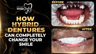 How Hybrid Dentures Can Completely Change Your Smile [upl. by Diraj]