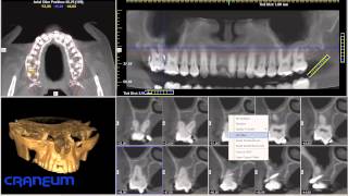 Tutorial CRANEUM iCat Vision  parte1  Tomografia Computadorizada Volumetrica  Cone Beam [upl. by Enaoj]