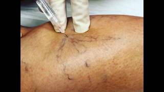 Sclerotherapy with asclera [upl. by Phyllis]