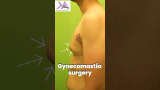 Smooth amp Seamless  Gynecomastia Surgery  Gyno Surgery Results painless plasticsurgery [upl. by Mcmurry]