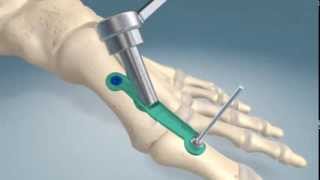 1st metatarsalphalangel joint fusion procedure [upl. by Dnalor]