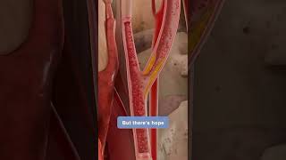 Exploring Atherosclerosis Understanding PlaqueBuildup in Arteries medicalstudent anatomyfacts [upl. by Alexis]