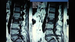 Spine Lecture Kyphoplasty [upl. by Lacy]