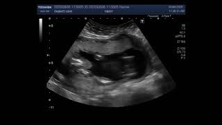 Ultrasound Video showing Pregnancy of about 18 weeks with Anencephaly [upl. by Robaina10]