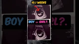 baby boy or baby girl10 weeks ultrasound 💜💙🤰shorts genderreveal baby ultrasound [upl. by Druci]