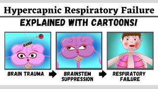 Hypercapnic type 2 respiratory failure explained with cartoons [upl. by Hnahk]