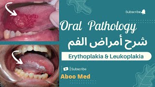 Erythroplakia amp leukoplakia 1 pathology amp systemic diseases related to oral pathology شرح أمراض الفم [upl. by Charo]