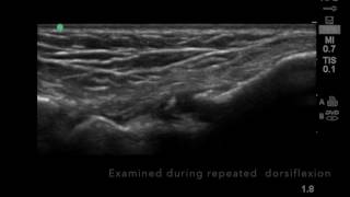 Ultrasound of anteromedial ankle impingement [upl. by Aneleasor]