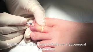 Nail Biopsy to Rule out melanoma under the nail [upl. by Leahci827]