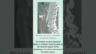 Median arcuate ligament syndrome  MALS [upl. by Judi450]