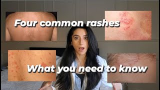 Four common rashes and everything you need to know about them [upl. by Renata501]