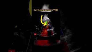 Perimembranous Ventricular Septal Defect  VSD echocardiography cardiology [upl. by Ilrahs393]