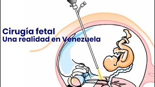 Cirugía fetal Una realidad en Venezuela [upl. by Macrae883]