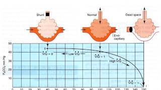 20170331 Effect of Ventilation perfusion imbalance on gas exchange [upl. by Aydidey506]