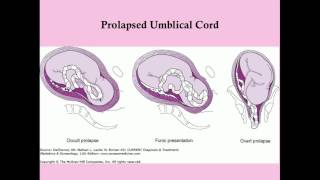 Obstetric Complications of Labor  CRASH Medical Review Series [upl. by Smalley]