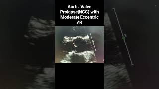 Aortic Valve Prolapseaffecting NCC with Moderate Eccentric anteriorly directed AR [upl. by Aerbas159]